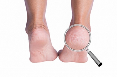 Get Rid of Dry or Cracked Heels  North Florida Foot & Ankle Center