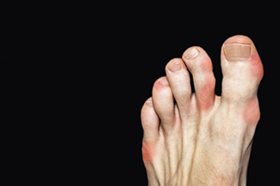 what-is-gout